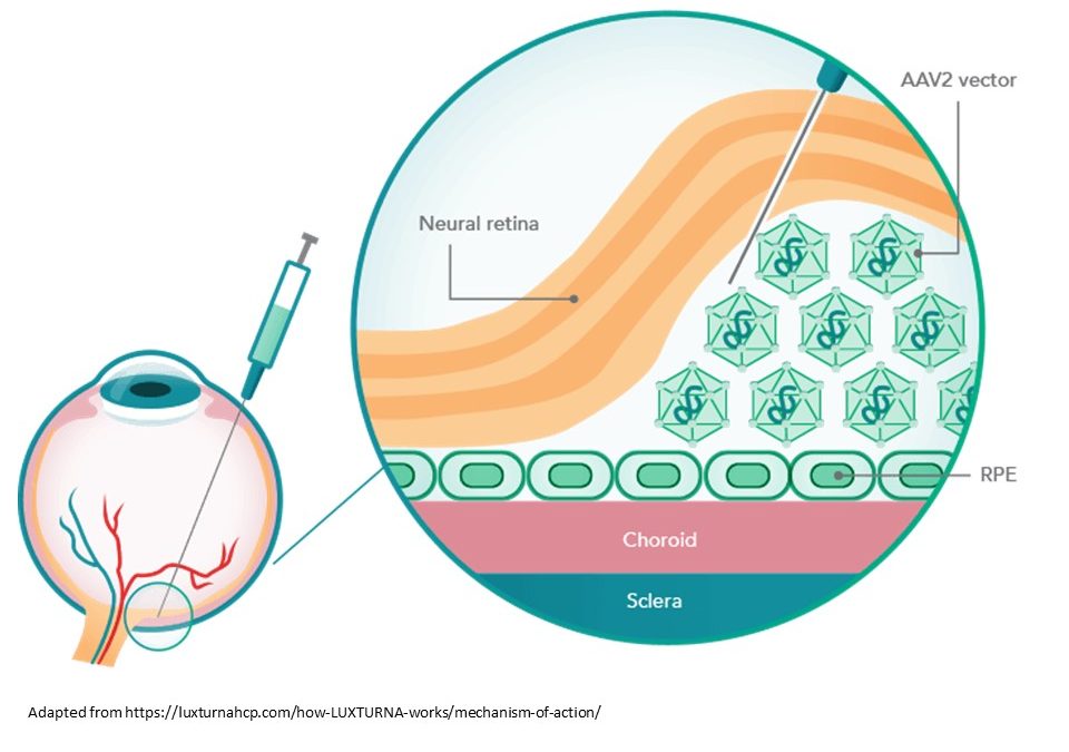 Luxturna, a turning point in advanced therapy treatment