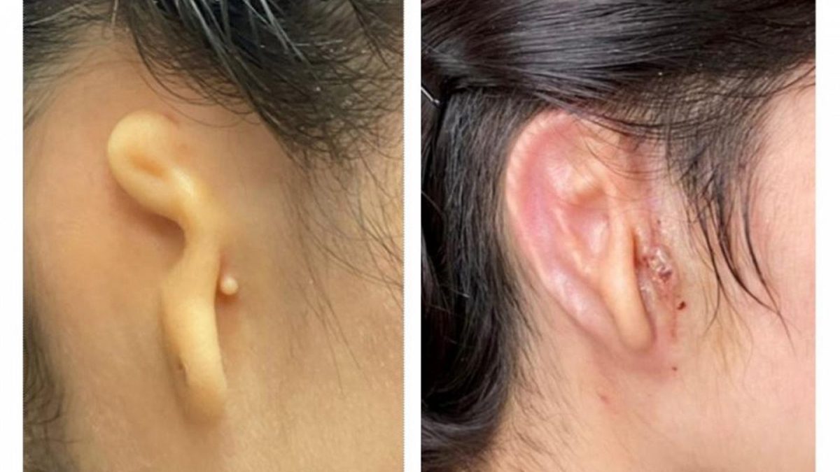 Successful Transplant of the first 3D printed ear: how did they do?